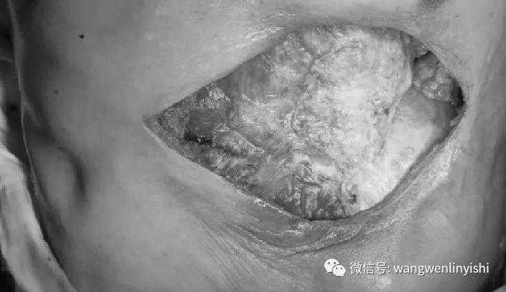 Excision of the lesion, costal arches, costal cartilages, and parts of the ribs