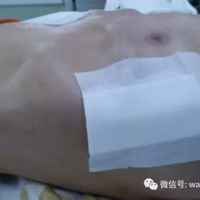 Chest wall contour after the surgery