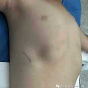 before surgery
