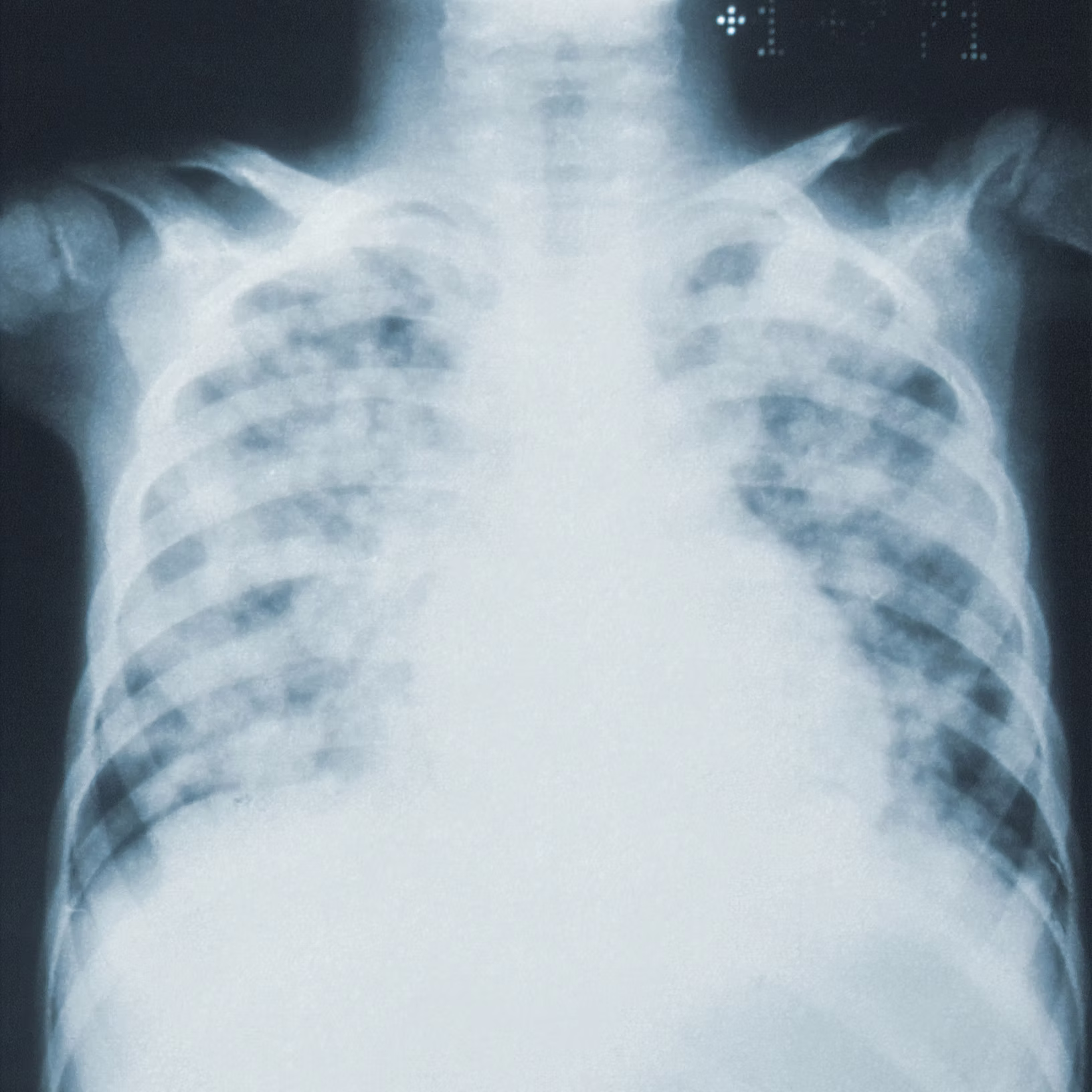 Journal of Chest Wall Surgery: The world&rsquo;s first chest wall specialty journal now launched