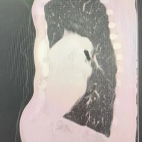 The anterior chest wall deforms severly, with clear compression on the heart.