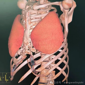 The prosthetics are positioned on the anterolateral chest wall, and there is significant narrowing of the thoracic cage along with restricted lung expansion.