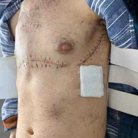 After surgery, the chest has returned to its normal size, and the narrowing has been eliminated.