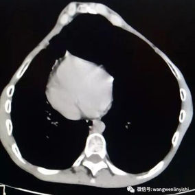 CT scan shows that the anterior chest wall protrudes severely, resulting in a considerable gap between the heart and the anterior chest wall