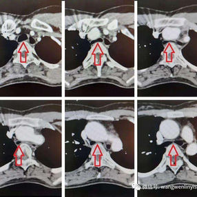 (Compression of the trachea is evident due to the reduced space between the thoracic spine and the anterior chest wall