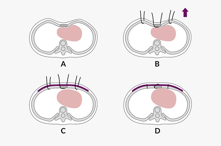 Surgical Technique